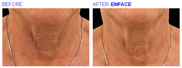 emface14
